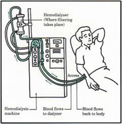 P14T4_Haemodialysis.jpg