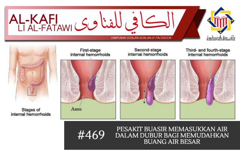 Pejabat Mufti Wilayah Persekutuan - AL-KAFI #469: PESAKIT 